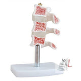Cutaway Osteoporosis- 